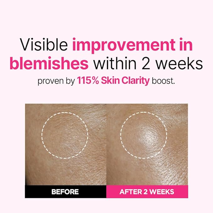 ISOI Blemish Care Up Serum for Face, Vegan Hydrating Serum for Smooth & Glass Skin Effect, Skin Barrier & Moisture Balance for Women, Korean Skin Care (0.85 fl. oz, 25ml)