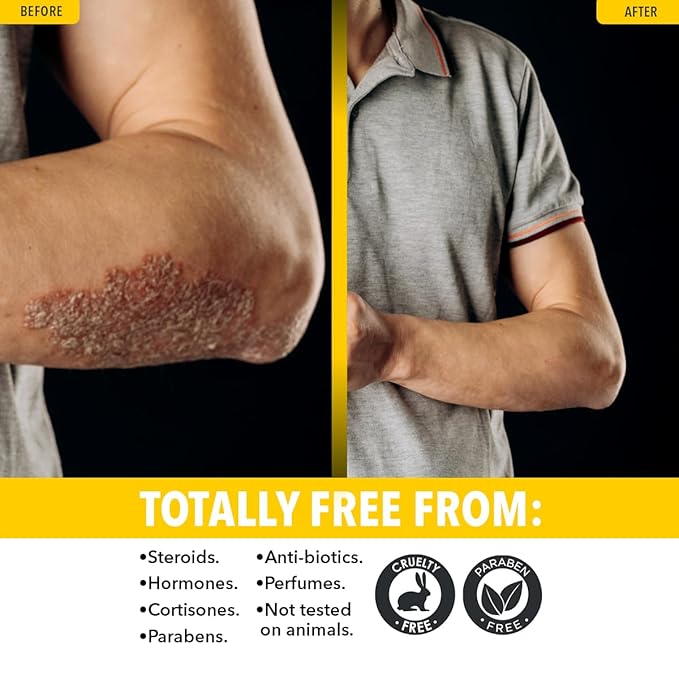 Dr. Robaina Sulfur Balsam Lotion – Lightweight Moisturizer for Dry, Flaky & Itchy Skin – Calms Redness, Supports Skin Barrier & Locks Hydration – Shea Butter & Tea Tree – 8 fl oz, USA Made