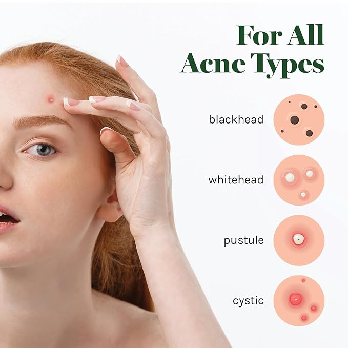 AOA Studio Absorbing Cover Healing Invisible Acne Patch Blemish Spot, Treatment, Facial Acne Patch Vegan, Cruelty Free, Hydrocolloid, Two Sizes 10mm 12mm (Total 84 Counts)