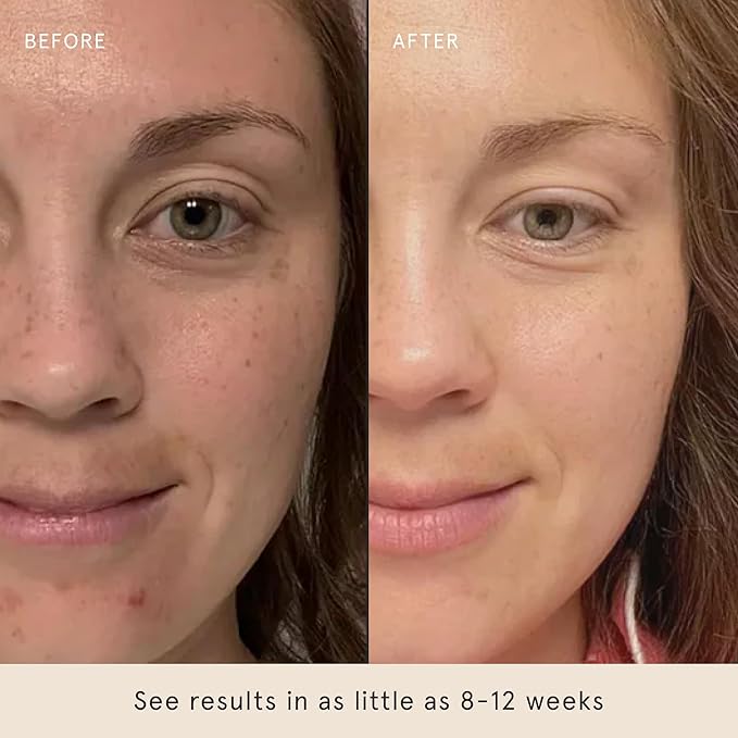 Barefaced Brightening Serum 1 Fl Oz Dark Spot Corrector with Kojic Acid, Arbutin, Azelaic Acid & Licorice, Anti-Aging, Hydrating, Fades Hyperpigmentation & Evens Skin Tone, Antioxidant-Powered Formula