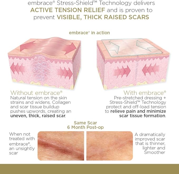 Embrace Scar Treatment, Silicone Sheets for New Scars with Active Scar Defense, Extra Large 6.3 Inch Sheets, 60 Day Supply (Recommended Treatment)