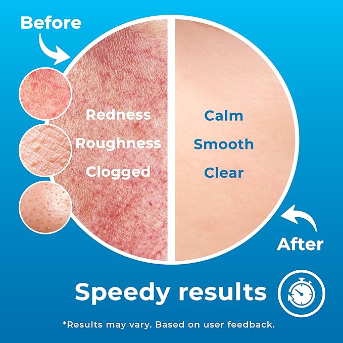 Hypochlorous Acid Spray (8oz, 2 packs), HOCL Facial Cleanser Acne Spray for Face, Body, Eczema, Pimples, Breakouts & Overall Skin Recovery (Reduces Redness)