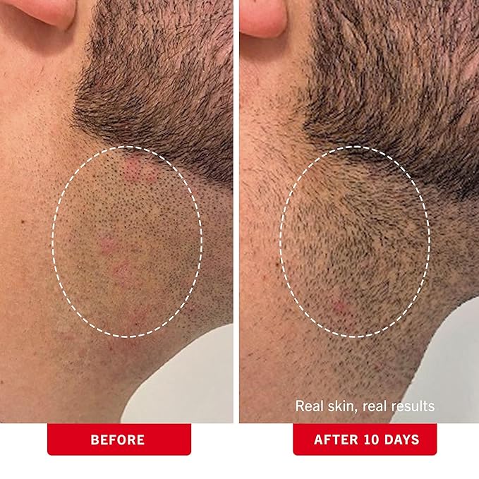 First Aid Beauty - Ingrown Hair Pads with BHA + AHA - Aftershave Treatment Pads to Help Prevent Razor Bumps for Men & Women - Exfoliate Underarms & Bikini Area - Compostable for Daily Use - 28 Pads